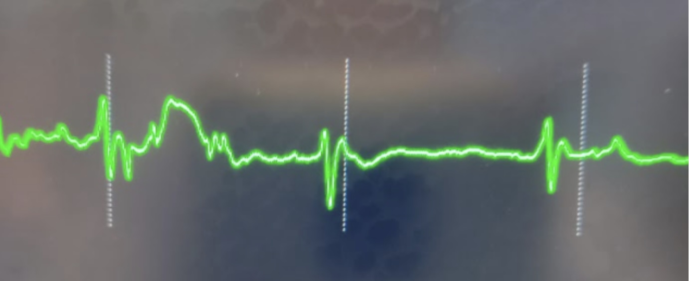 ecg