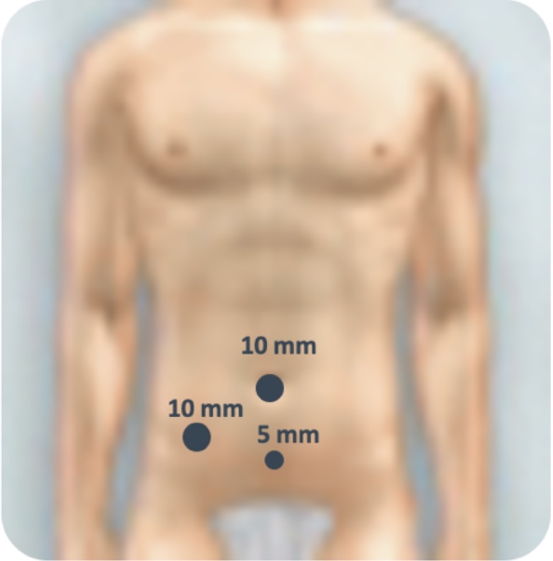 trocartes